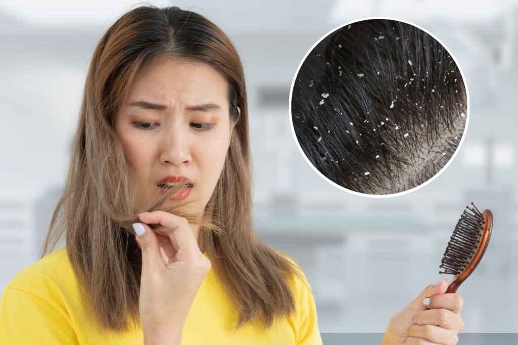 Can Dandruff Cause Hair Fall