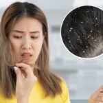 Can Dandruff Cause Hair Fall