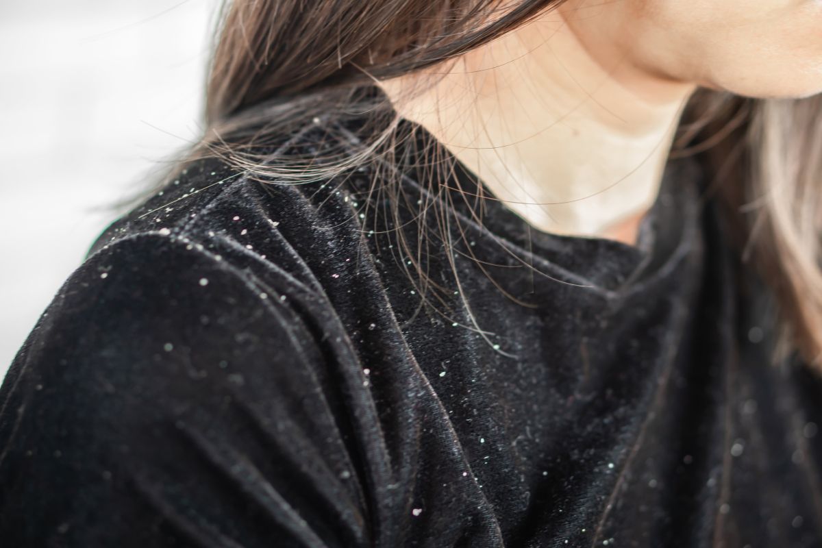 How Dandruff Can Contribute to Hair Fall